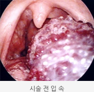 시술 전 입 속 사진 모습