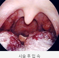 시술 후 정맥크기가 줄어든 입 속 사진 모습