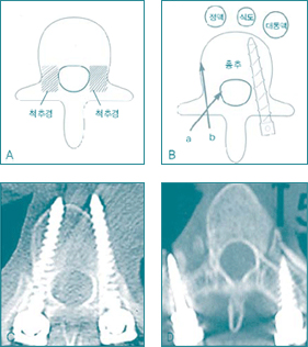 척추뼈 나사못 삽입 그림