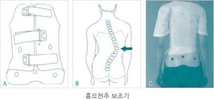 흉요천추 보조기 사진