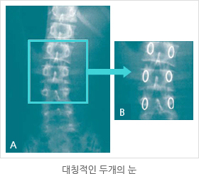 대칭적인 두개의 눈 비교 사진