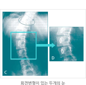 회전변형이 있는 두개의 눈 비교사진