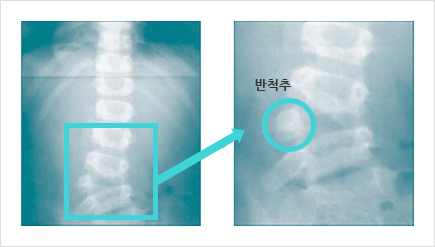 선천성 측만증 엑스레이 사진