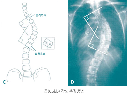 엑스레이로 검사하는 콥 각도 측정방법 사진