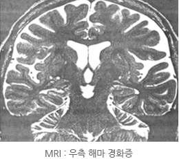 MRI로 촬영한 우측 해마 경화증 이미지 입니다.