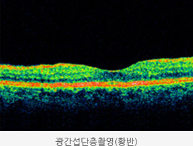 광간섭단층촬영(황반) 사진