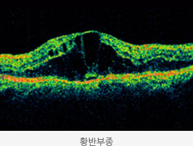 황반부종 사진