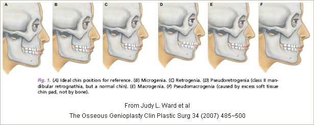 Mandibular prognathism