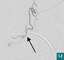나.기형혈관의 섭식동맥을 초선택한 혈관조영상 (화살표 = shunt) 모습
