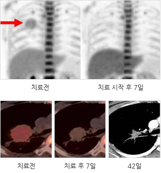 간세포암 사진