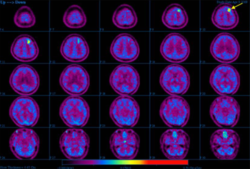 뇌종양 환자에서의 11C-Methionine 영상 사진