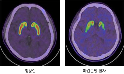 정상인과 파킨스병 환자 사진