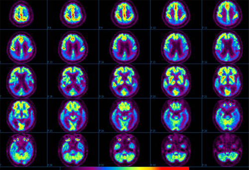 알츠하이머병 환자의 PET 영상 사진