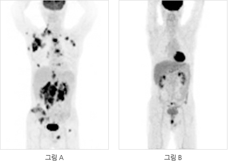 호지킨 림프종 환자의 전신 FDG PET/CT 영상 사진