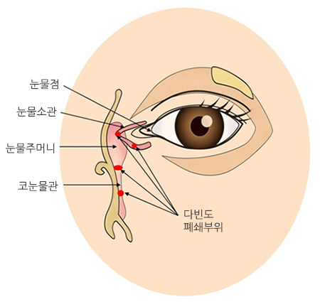 코눈물관 막힘