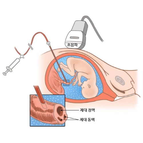 제대혈 천자의 시술하는 모습의 예시