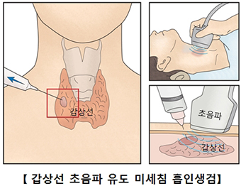 갑상선 초음파 유도 미세침 흡인생검