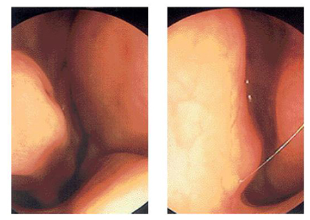 비중격이 한쪽으로 휘어져 코막힘이 나타난 환자의 비강 내시경소견