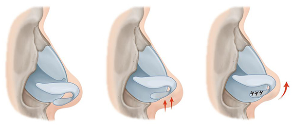 코 끝 연골을 위쪽으로 이동시켜 쳐진 코를 들어 올리는 수술 방법의 하나