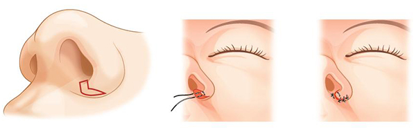 콧구멍의 안쪽과 바깥쪽을 절제하여 콧구멍의 크기를 줄여줄 수 있습니다