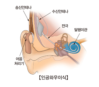 인공와우이식