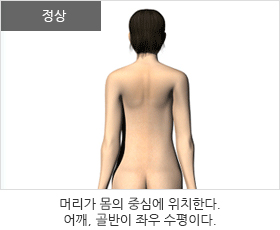 정상:머리가 몸의 중심에 위치한다. 어깨, 골반이 좌우 수평하다.