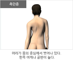 측만증이 있는 경우: 머리가 몸의 중심에서 벗어나 있다. 한쪽 어깨나 골반이 높다.