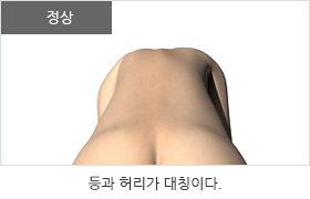 정상: 등과 허리가 대칭하다.