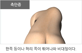 측만증이 있는 경우:한쪽 등이나 허리 쪽이 튀어나와 비대칭이다.