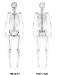 전신의 뼈에 고른 섭취가 보인 전신 X-ray 앞,뒤 사진 예시