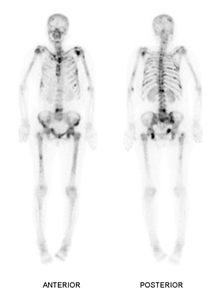 다발성 골 전이된 전신 X-ray 앞,뒤 사진 예시