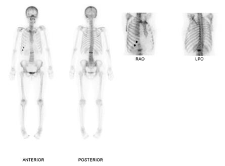 제2요추와 우측 7,8번째 늑골에 의한 섭취증가가 보이는 X-ray 앞,뒤및 확대 사진 예시