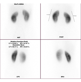 정상99mTc-DMSA신장검사 영상