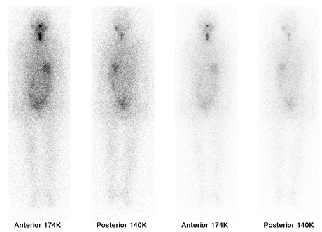 잔여 갑상선에 I-131이 섭취된 영상 사진 예시