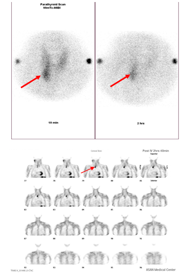 부갑상선 선종-부갑상선 스캔과 SPECT영상에서 우측 갑상선의 아랫부위에 국소적인 섭취를 보이는 부갑상선 선종 영상 사진 예시