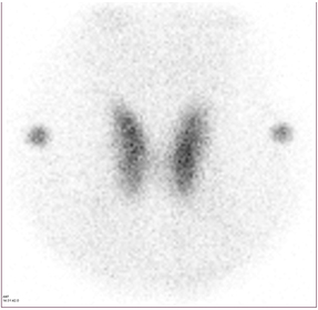 갑상선 좌우엽에 경계가 뚜렷하고 균등한 방사능을 보이는영상 사진 예시