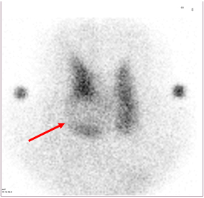 갑상선 우엽에 방사능이 감소한 결절이 관찰된 영상 사진 예시