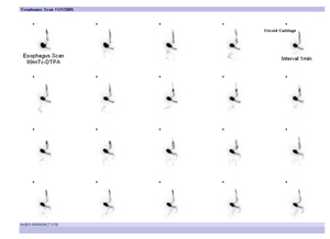 식도 이완불능증에 걸린 환자의 식도내 저류되어있는 음식물의 방사능이 관찰된 영상 사진 예시