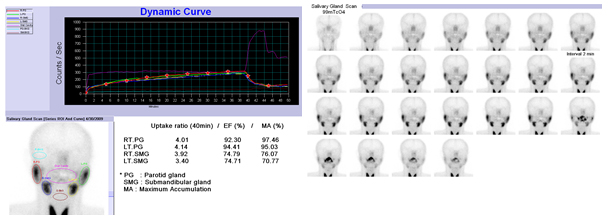 정상인의 타액선 영상 검사의 사진과 그래프 영상 사진 예시