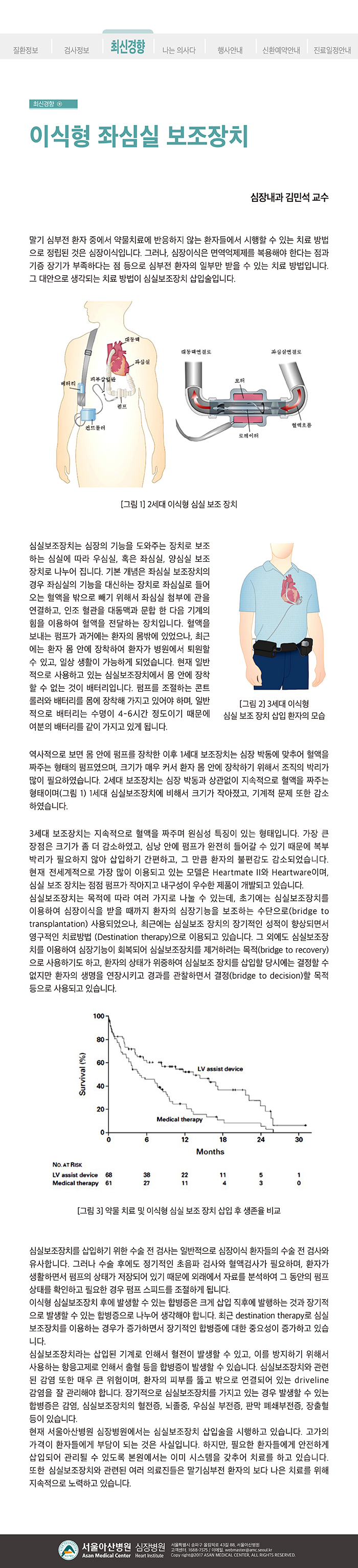 [아산심장소식지 2018년 봄호] 이식형 좌심실 보조장치