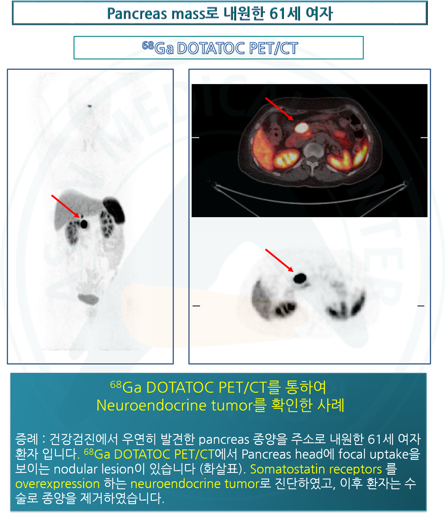 [Torso PET/CT(Ga-68 DOTATOC)]췌장 종양으로 내원한 61세 여자 | 핵의학 증례 영상 | 자료실 ...