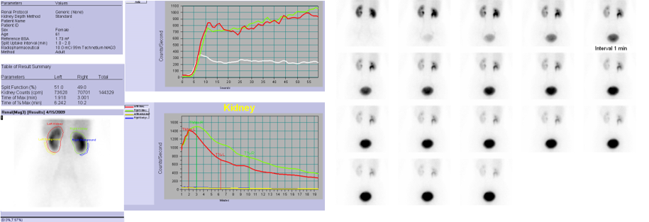 정상인의 99mTc-MAG3 신장검사 영상 사진 예시