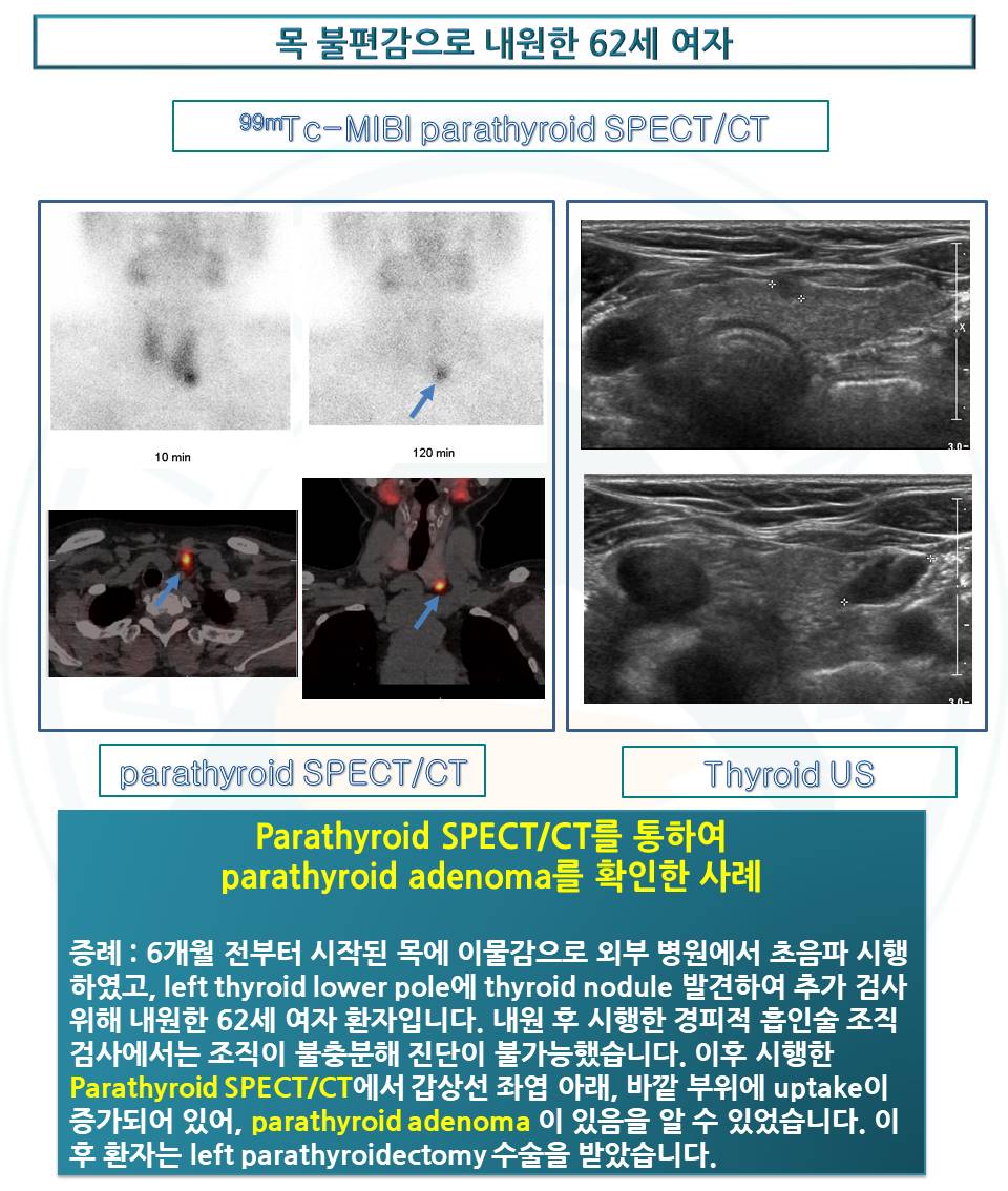 [Parathyroid SPECT/CT] 목 불편감으로 내원한 62세 여자 | 핵의학 증례 영상 | 자료실 | 핵의학과 | 서울아산병원