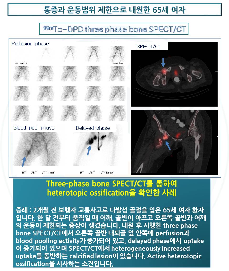 [Bone scan (3 phase)] 통증과 운동범위 제한으로 내원한 65세 여자 핵의학 증례 영상 자료실 핵의학과