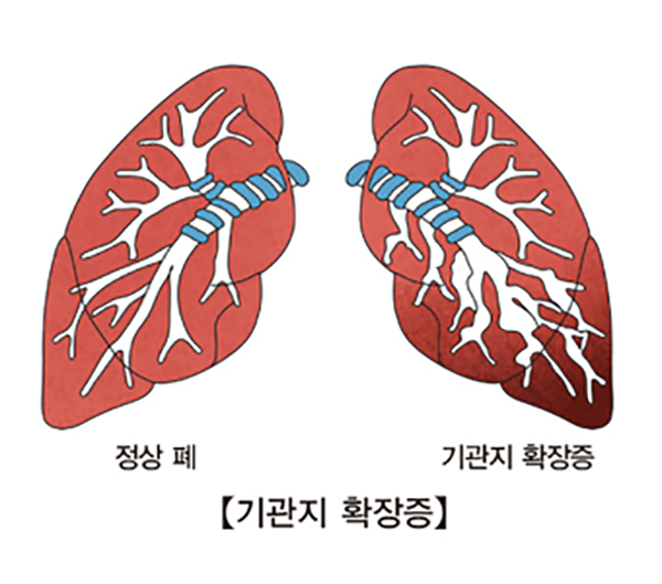 만성 호흡기 질환: 기관지 확장증 이미지