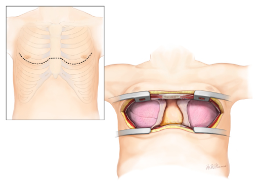 폐 이식: 폐이식 수술 후 관리 이미지