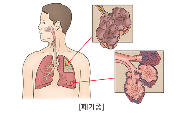 폐 실질과 흉곽내 기형: 선천폐엽폐기종 이미지