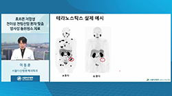 호르몬 저항성 전이성 전립선암 환자 맞춤 방사성 동위원소 치료