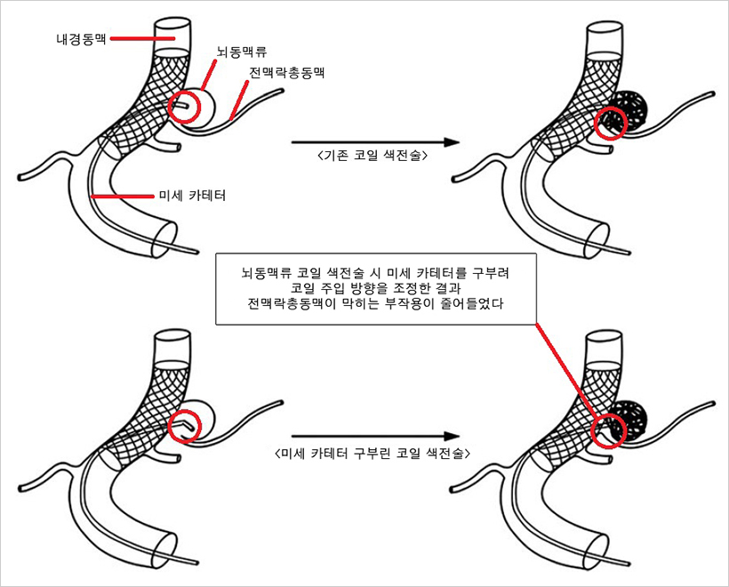 뇌동맥류 코일 색전술 방법에 따른 차이점