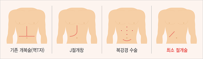 간 기증자 수술별 흉터 그림